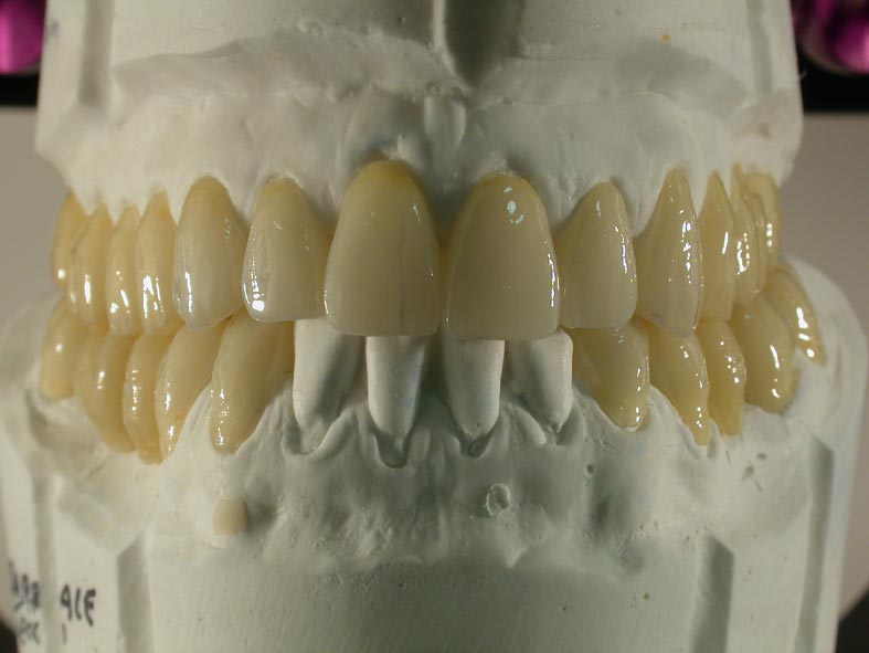 G-Provv-su-modello Denti provvisori su modello g