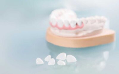La riabilitazione estetica con faccette in ceramica