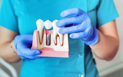 Impianti dentali, indicazioni d’uso nelle ricostruzioni in odontoiatria estetica