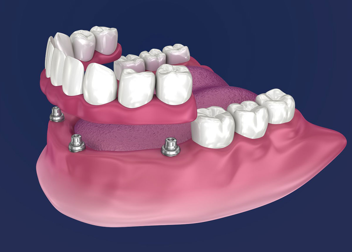 overdenture stampante laser