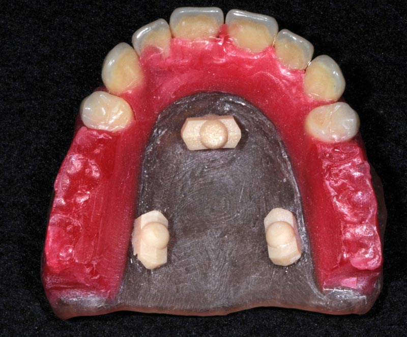 1.5-IN-ALLUMINA-DOPO-VESTIBOLARE corona in allumina dopo